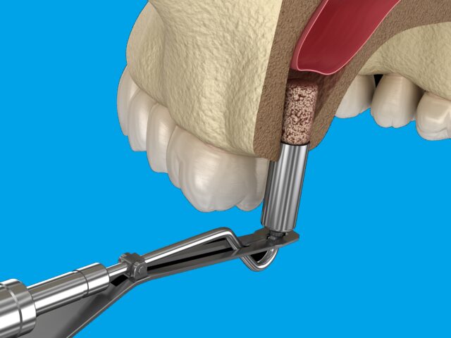 Sinus lift to podniesienie dna zatoki Łódź celem odbudowy kości pod implant zębowy.