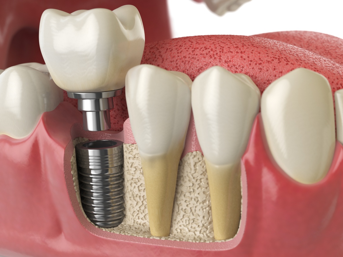 Implant zęba Łódź