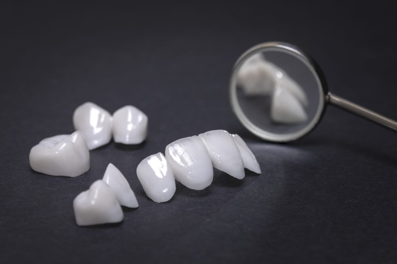 Korony Łódź wykonane z materiału wysoce estetycznego i wytrzymałego jak porcelana to częsty wybór na odbudowę słabych zębów
