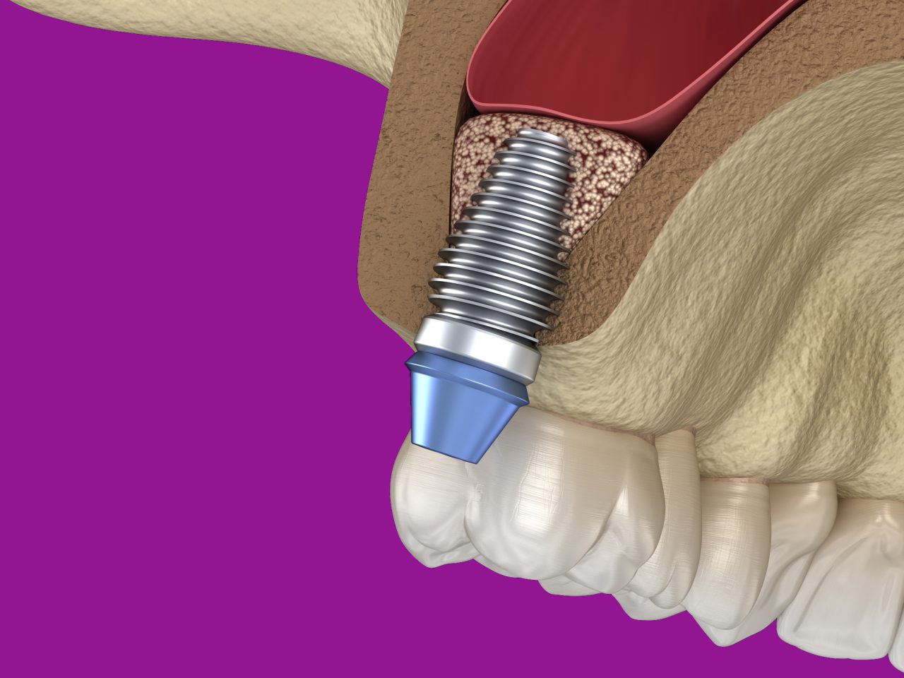 Podniesienie zatoki szczękowe Łódź czyli sinus lift to popularna procedura umożliwiająca wszczepienie implantów zębowych