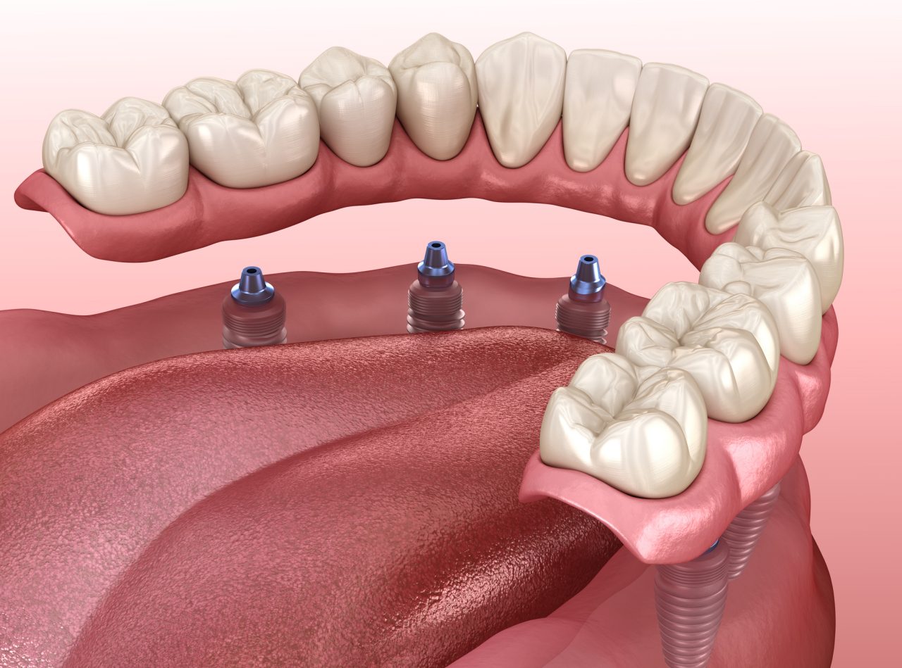proteza na implantach